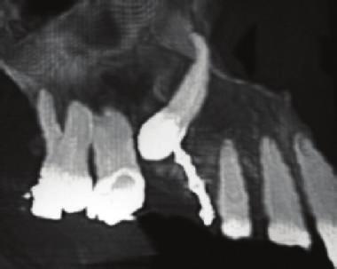 Despite that, the maintenance of the tooth was performed because the reduced bone volume in the affected canine could compromise the facial aesthetic at the end of the treatment.