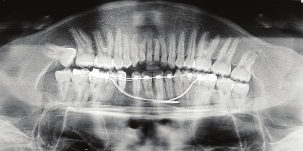 The appropriate direction of eruption for a palatally impacted canine is essential for correcting the impaction and bringing the tooth to its correct position.