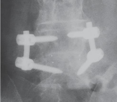 pedicle screw constructs, titanium cages, infuse bone morphogenetic (BMP) and dbx putty. Both failed.