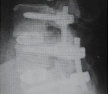 radiograph EVOS-HA cage and pedicle screws of EVOS HA cage and pedicle screws 6-month axial CT scan