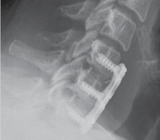 cervical discectomy and fusion at C5-C7 utilizing a PEEK-OPTIMA HA Enhanced Interbody Fusion Device.