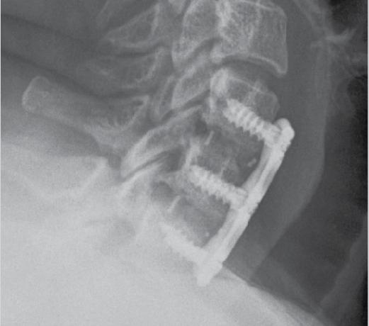 6-month Flexion Extension radiographs demonstrating solid fusion The patient resumed bucket truck work after eight weeks, and reported no further