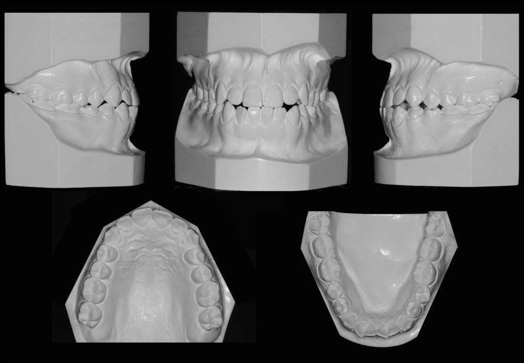 386 Ruellas et al Fig 2. Initial dental casts. Fig 3. Initial radiographs: A, cephalometric; B, frontal; C, periapical; D, panoramic.