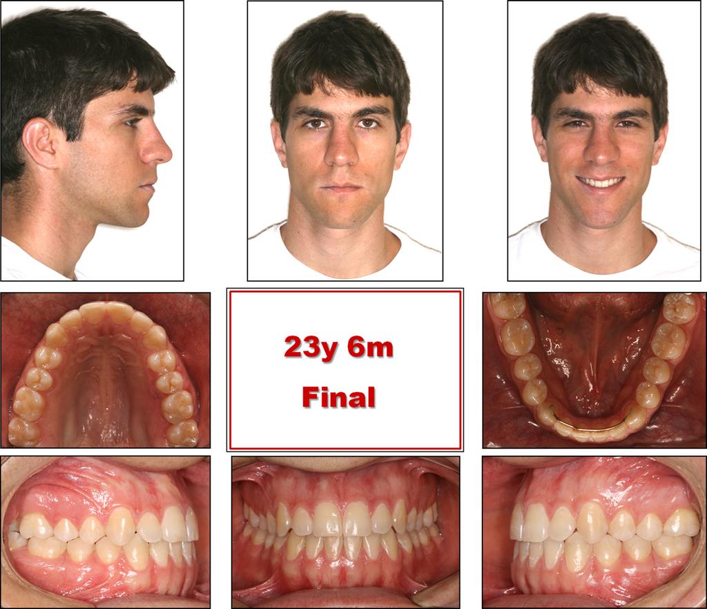 Ruellas et al 389 Fig 6. Final extraoral and intraoral photographs.