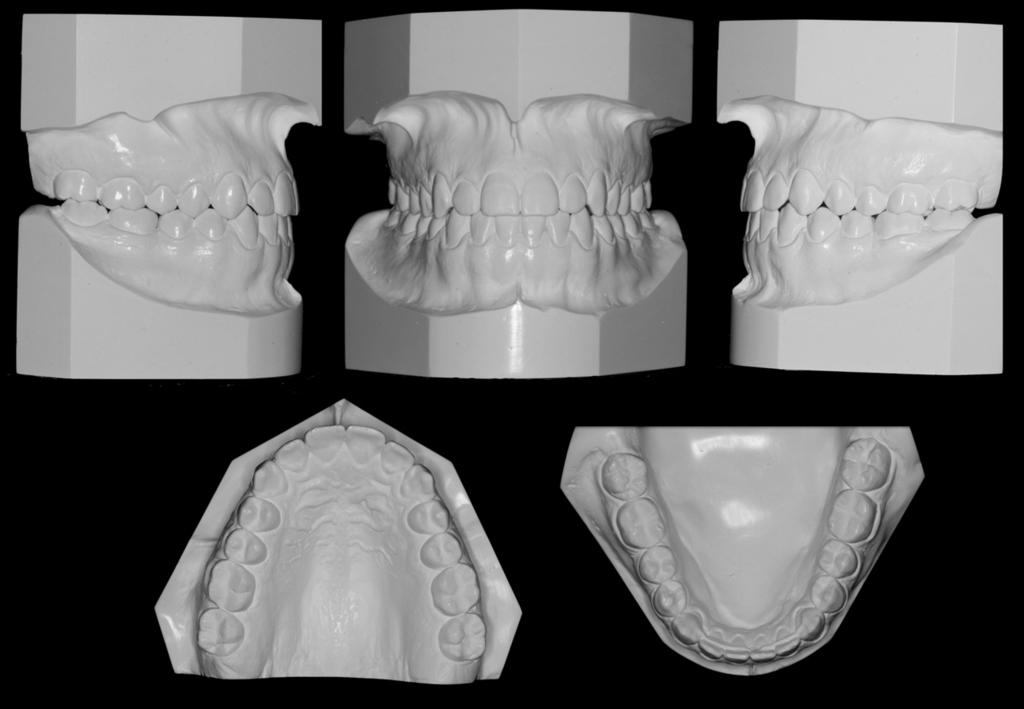 390 Ruellas et al Fig 7. Final dental casts. Fig 8.