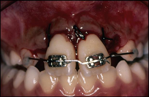 TREATMENT PROGRESS The central incisors were splinted, and a surgical procedure was used to remove the elastics (Fig 3).