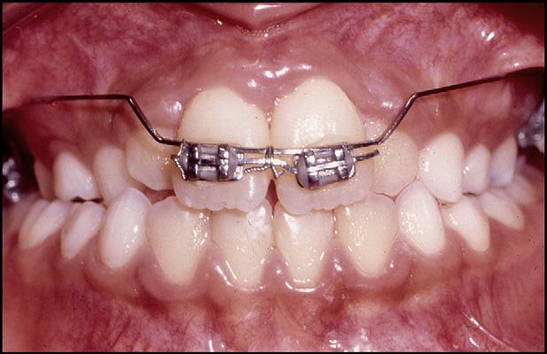 During surgery, no scaling was performed on the roots to maintain any remnants of the periodontal ligament.