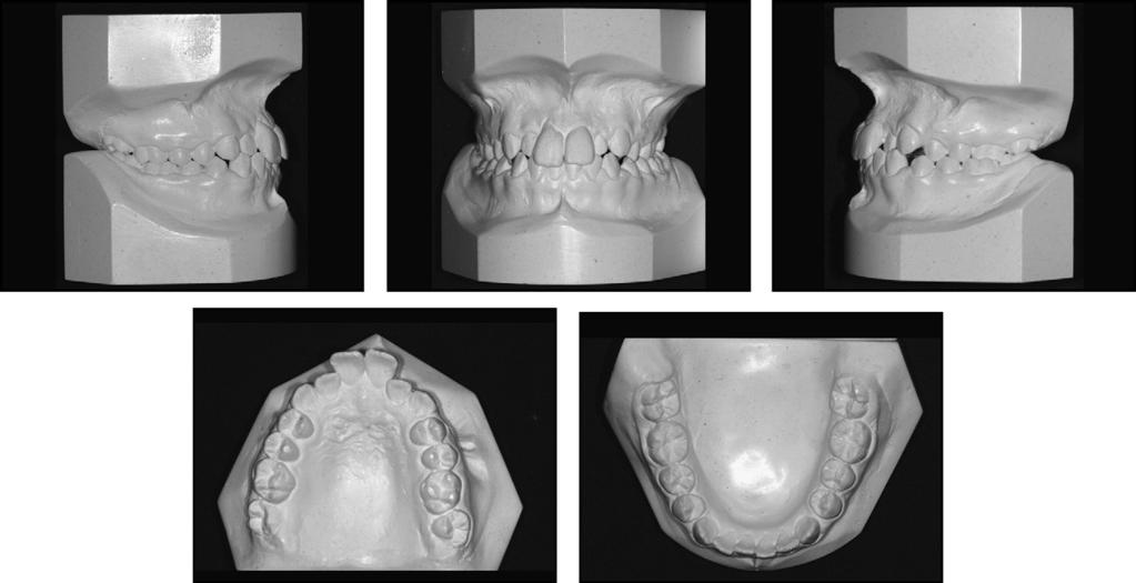 274 Almeida et al Fig 7. Dental casts before the second stage of treatment. Fig 8. Radiographs before the second stage.