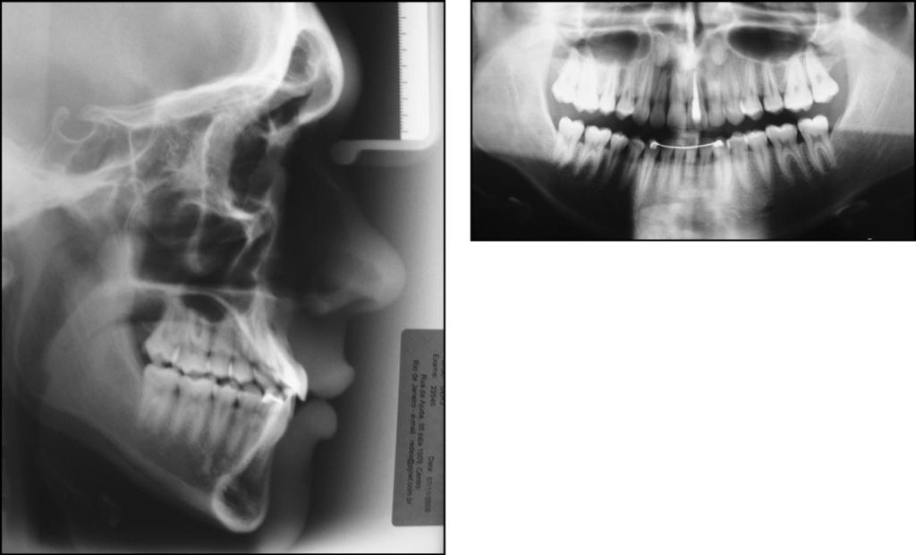 276 Almeida et al Fig 10. Dental casts after the second stage of treatment. Fig 11.
