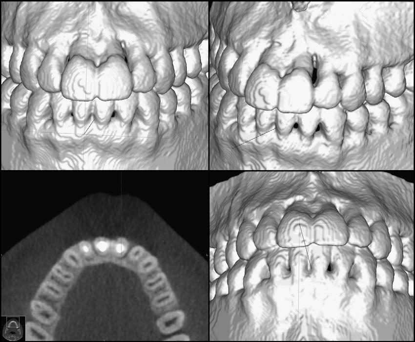 Almeida et al 277 Fig 12. Tridimensional image of the bone defect on the central incisors after treatment. surfaces. On the mesial surface, the roots were approximated and caused a severe bone defect.
