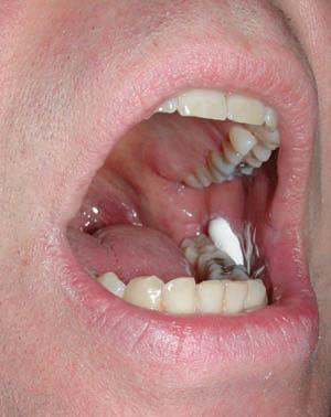 Sublingual or buccal route For sublingual and buccal