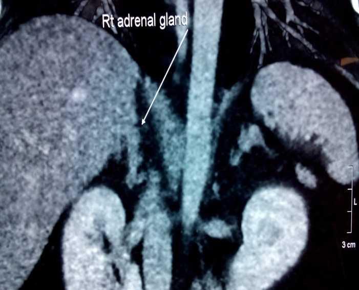 Investigation - imaging CT adrenals: