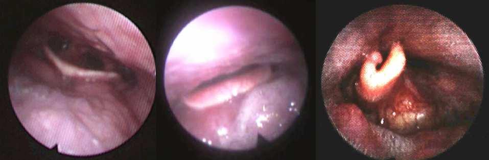 Endoscope Back of Tongue and