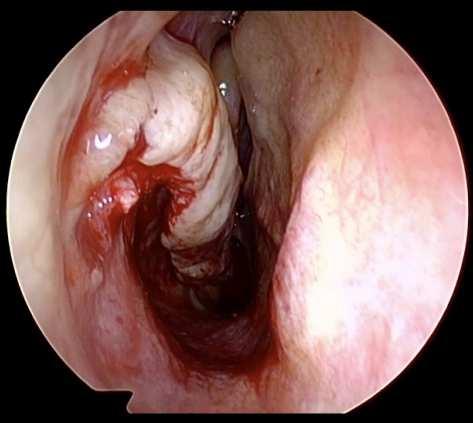 Lingual tonsillectomy
