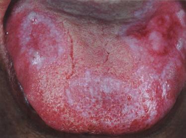 576 Aloe vera in oral lichen planus, C. Choonhakarn et al. Fig 3. Erosive lesions on the tongue; clinical improvement after an 8-week treatment with aloe vera gel.