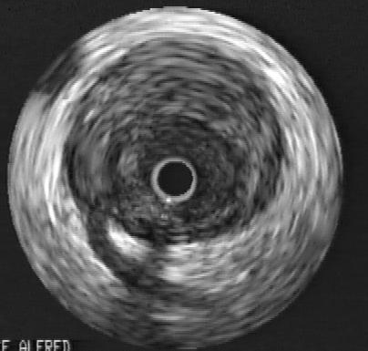 IVUS assessment - Atherosclerosis regression 2%