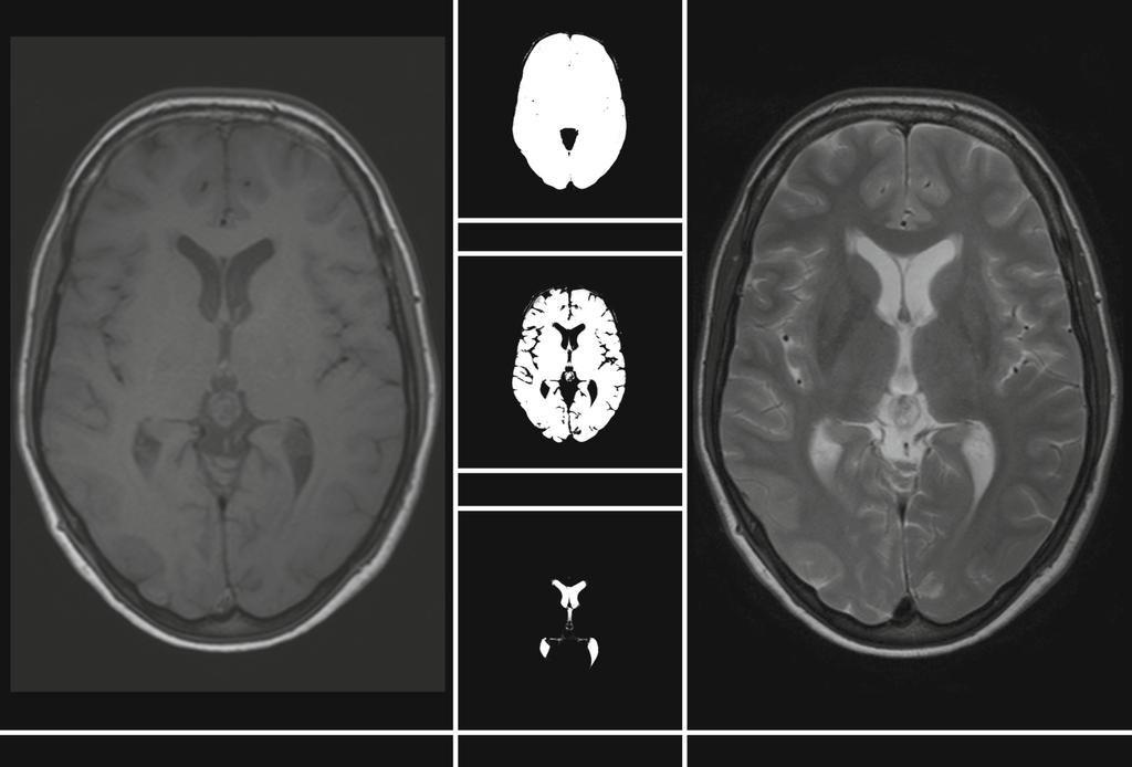 Neuroradiology (2015) 57:269 274 271 ICV Cerebral parenchyma Lateral ventricles T1-weighted MRI image T2-weighted MRI image Fig. 1 Example of the segmentations of supratentorial volumes.
