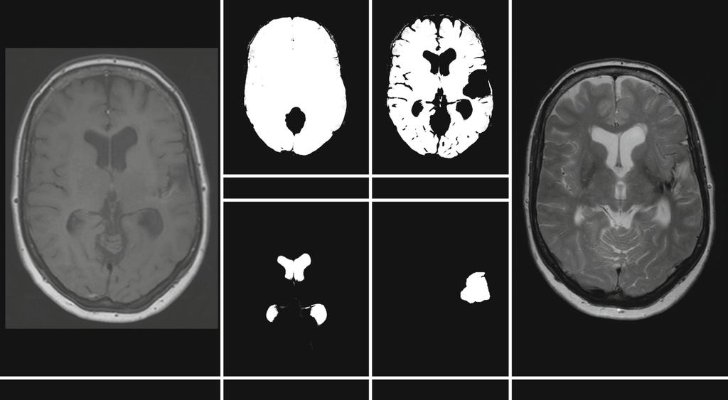 T1-weighted MRI image ICV Cerebral parenchyma Lateral ventricles Infarct Fig. 2 Example of the segmentations in a participant with a cerebral infarct.