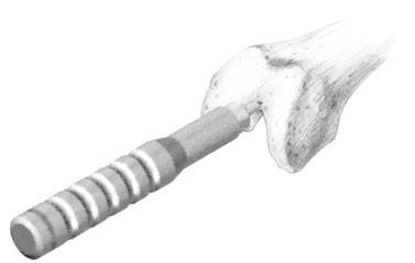 anterior to the anterior insertion of the PCL into the femur.