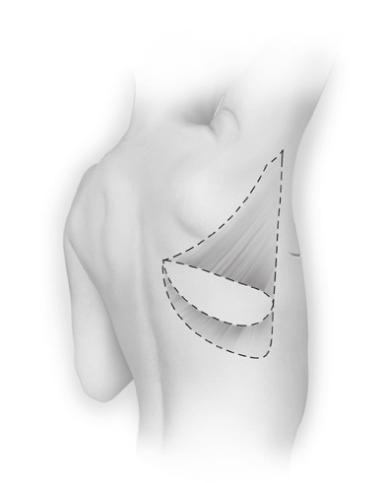 16 10647-03 The Latissimus Dorsi Flap With or Without Breast Implants A skin flap and muscle are taken from donor site in the back.