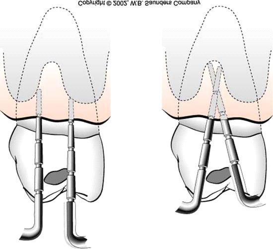 Figure 4: Probe indicates a probing depth of 5 mm measured from the gingival margin Figure 5: Incorrect angle correct angle Figure 6: Incorrect angle (Over-angulation) III - Gingival Recession