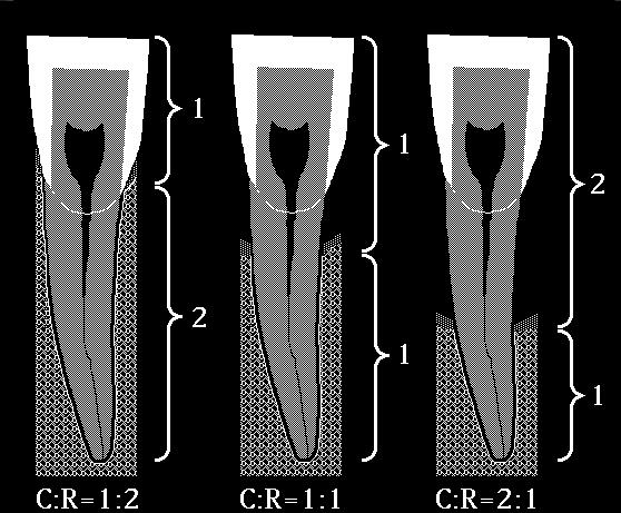consideration while making individual tooth diagnosis. Loss of Crestal Bone Density Examine the crestal lamina dura for its continuity.
