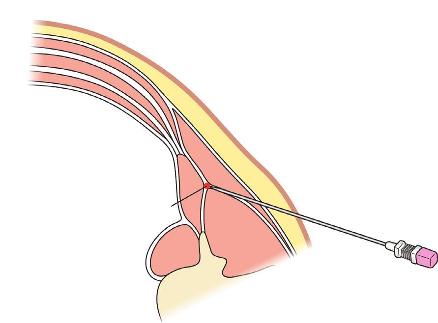 2 PainResearchandManagement EO IO TA EO IO TA EO IO TA LD QL LIFT ES PM LD QL LIFT ES PM LD QL LIFT ES PM (a) (b) (c) Figure 1: Illustration demonstrating the needle trajectory and tip location of