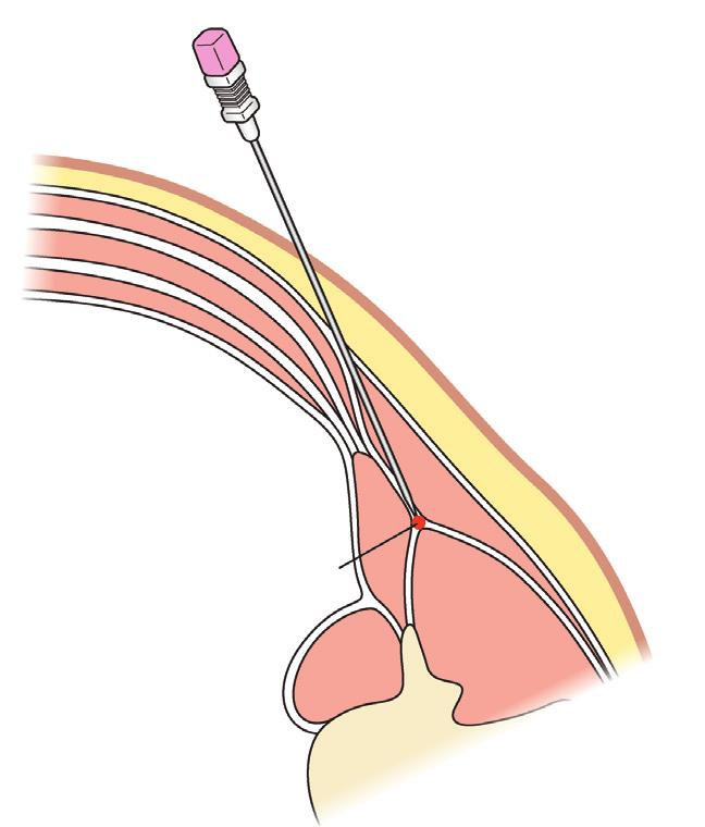 With an anteroposterior needle trajectory, the target injection point of a lateral QL block(a) is the anterolateral margin of the QL, and