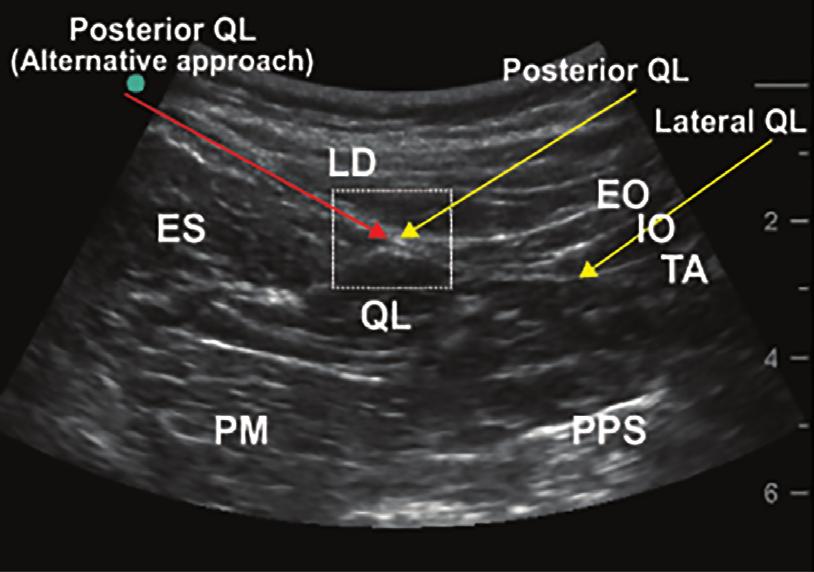 PainResearchandManagement 3 (a) (b) Figure 2: (a) Ultrasound image demonstrating the needle trajectory and tip location of the three different approaches to the ultrasoundguided QL block.