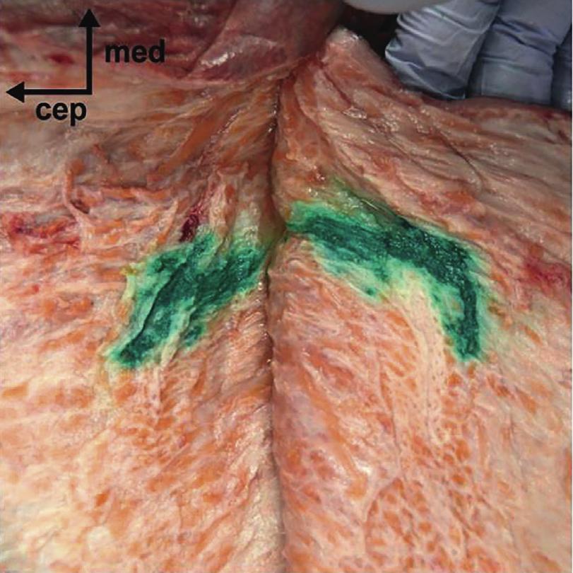 Pain Research and Management 5 (a) (b) (c) (d) Figure 3: Cadaveric dissection following conventional lateral and posterior QL blocks. (a) Dye-stained subcutaneous tissue in a posterior QL block.
