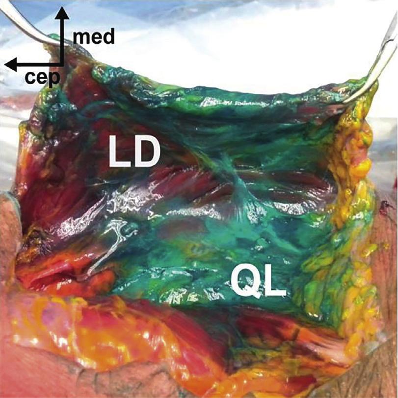 (ES, erector spinae; LD, latissimus dorsi; QL, quadratus lumborum; EO, external oblique muscle; PM, psoas major; TLF, thoracolumbar fascia; TF, transversalis fascia).