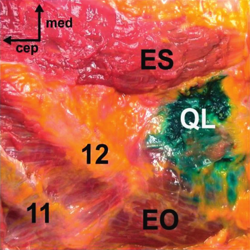 6 Pain Research and Management (a) (b) (c) (d) Figure 4: Cadaveric dissection following the posterior QL block with an alternative needle approach. (a) The deeply stained middle layer of the TLF.