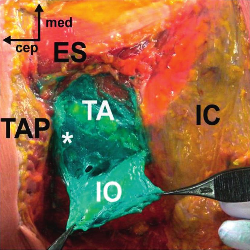 (d) The TF plane was deeply stained, but the PPS was preserved (ES, erector spinae; QL, quadratus lumborum; IC, iliac crest; EO, external oblique muscle; IO, internal oblique muscle; TA, transversus