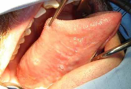 The site of the harvest graft was the lateral mucosal lining of the tongue The length of the