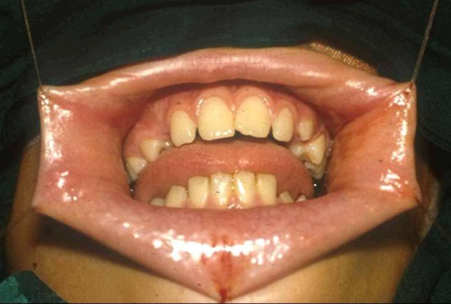 Harvesting oral mucosal