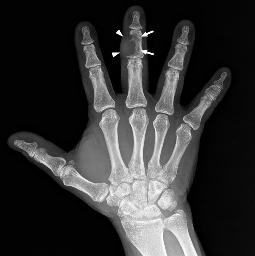 one ws noted within the oundry of the mss. The mss utted with the flexor tendon of the third finger (Fig. 1).