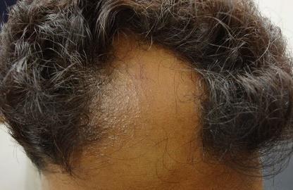Alopecia areata multilocularis.