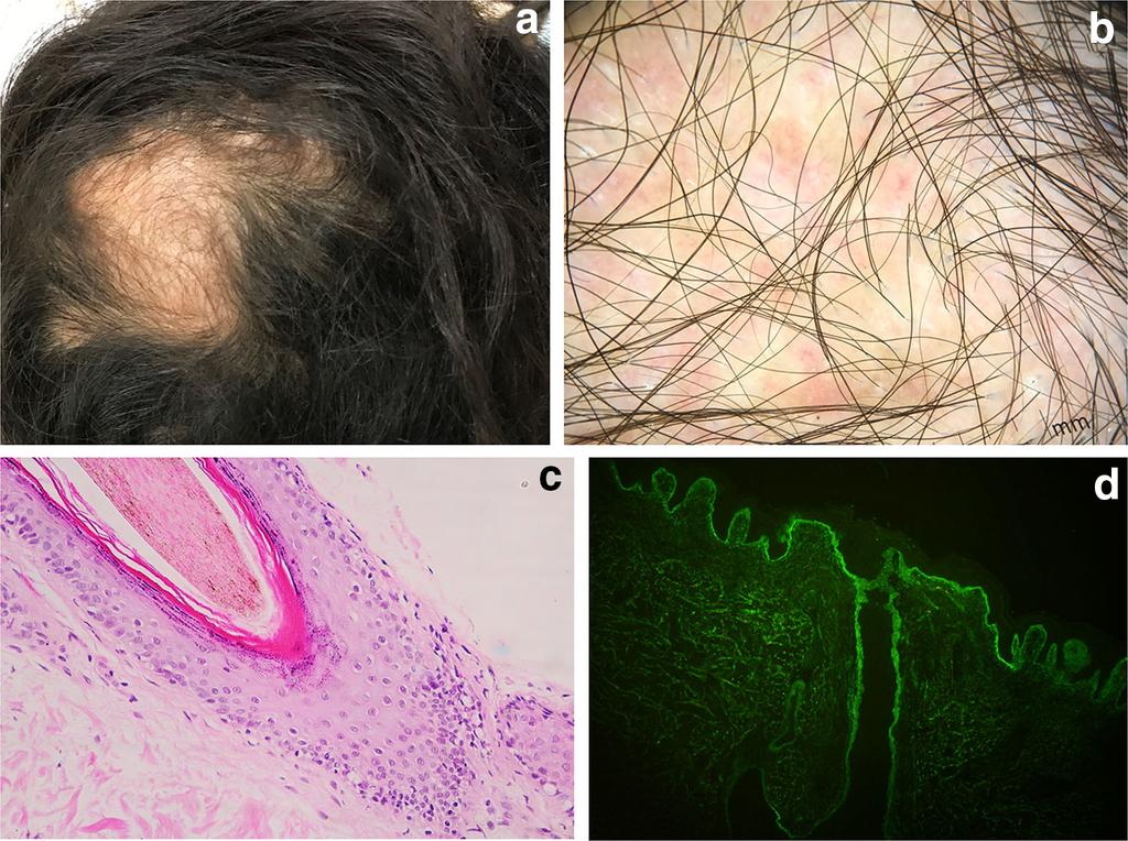 S. Udompanich et al. Fig. 5 Patchy, non-scarring alopecia in systemic lupus erythematosus. a Solitary, welldefined non-scarring alopecia on the left vertex.
