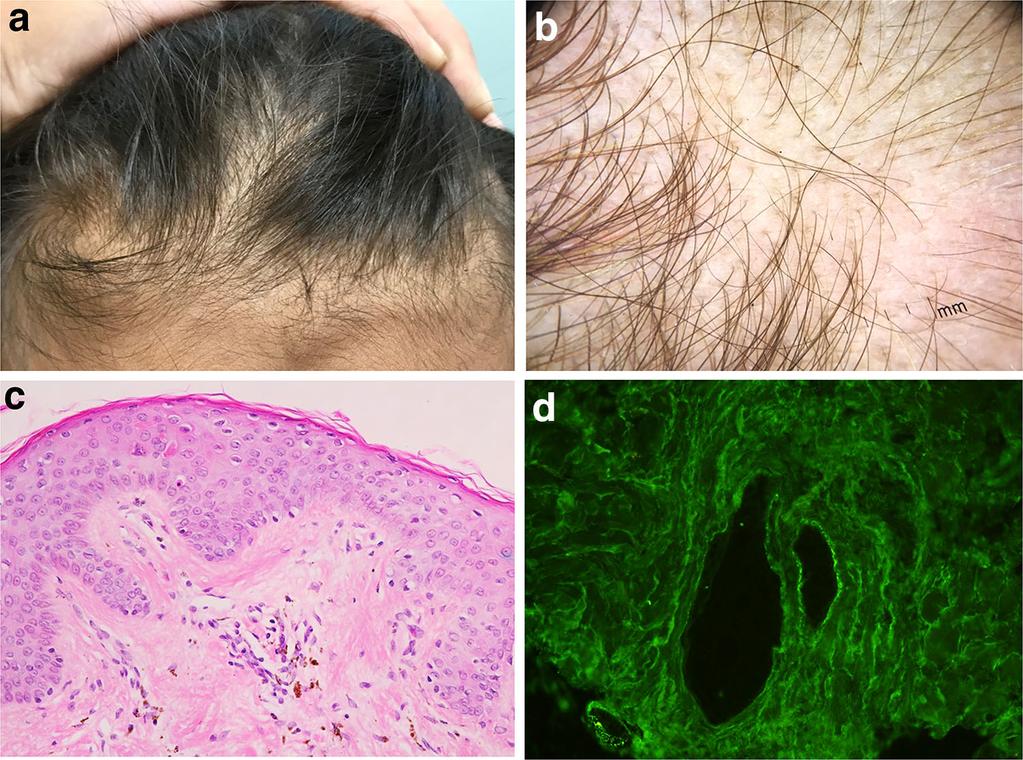 S. Udompanich et al. Fig. 6 Lupus hair. a Frontal hairline recession with short, coarse, dry, and lustreless hair.