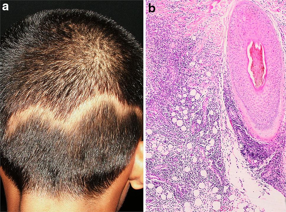 Hair and scalp changes in cutaneous and systemic LE patients had recurrence on the same or different parts of the scalp. 5 Miscellaneous Findings Fig.