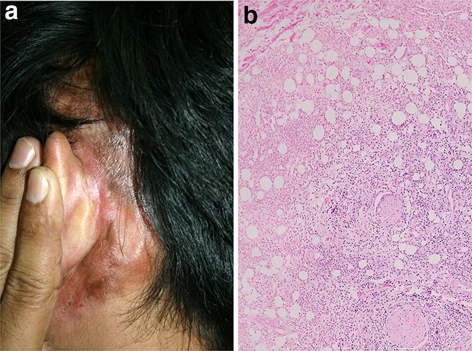 S. Udompanich et al. Fig. 1 Discoid lupus erythematosus. a Two focal areas of round plaques, the right showing adherent scale with follicular plugging, and the left showing central atrophy.