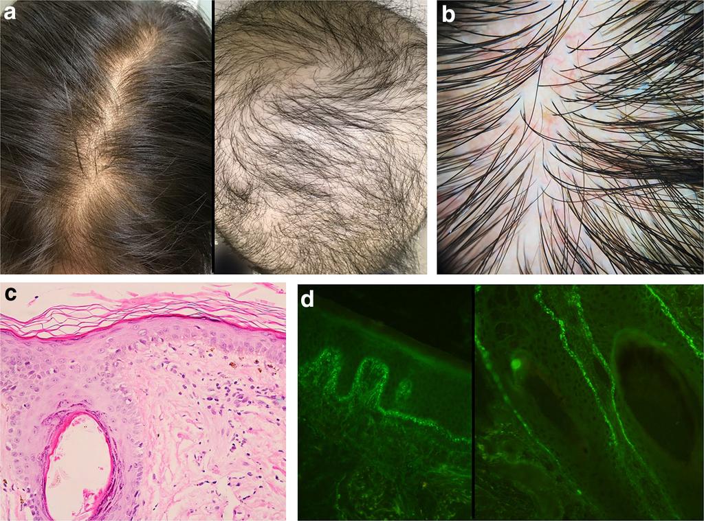 Hair and scalp changes in cutaneous and systemic LE Fig. 4 Diffuse non-scarring alopecia in systemic lupus erythematosus. a Mild diffuse non-scarring alopecia and severe diffuse nonscarring alopecia.