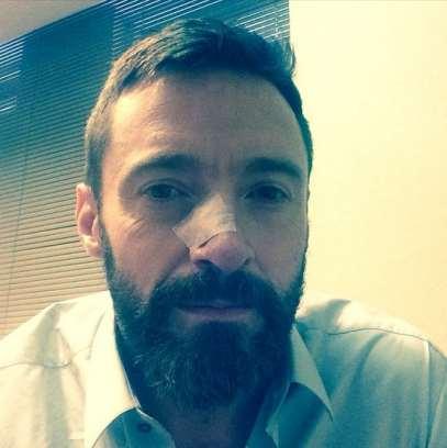 Hugh Jackman's Skin Cancer Returns; Actor Receives Treatment For Basal Cell Carcinoma Huffington Post 5/8/2014 "Another