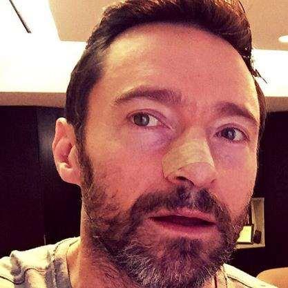 Hugh Jackman Treated for Skin Cancer on His Nose for the Fourth Time 2/8/16 "An example of what happens when you don't wear