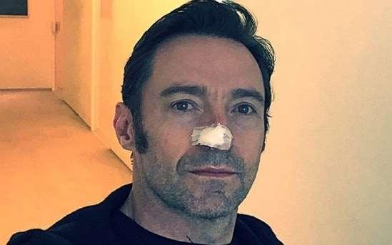 Hugh Jackman reveals another skin cancer treatment. CNN 2/14/17 "Another basal cell carcinoma.
