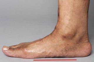 Flat foot (pes planus) Is a condition in which the medial