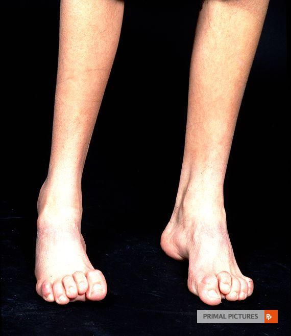 Pes cavus (claw foot) Is a condition in which the medial longitudinal arch is