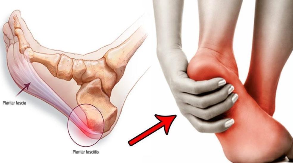 Plantar fasciitis It happens to person who is standing or walking for long time It causes pain and tenderness of the