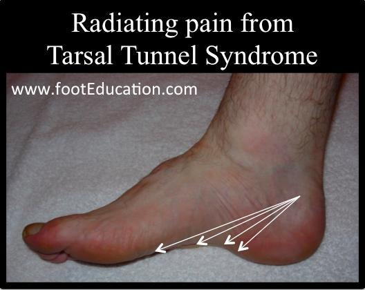 Tarsal tunnel syndrome Due to