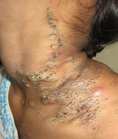 Two cases of nevus flammeus had generalized unilateral distribution.